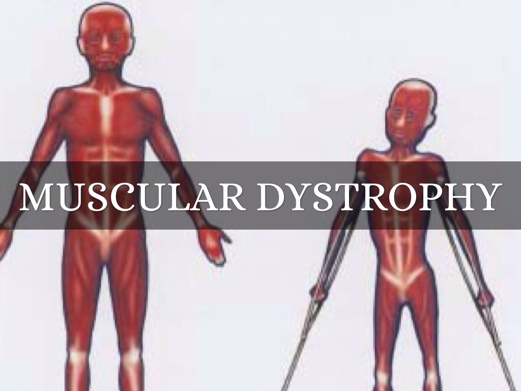 Muscular Dystrophy by Shannon Stover