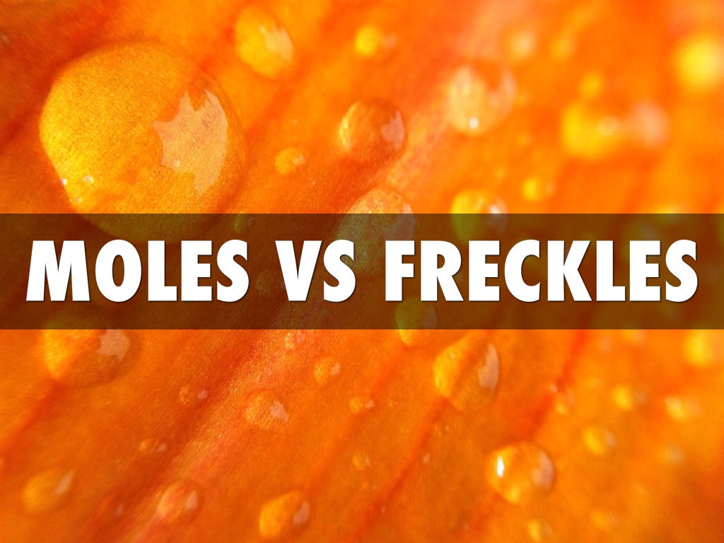 Moles & Freckles