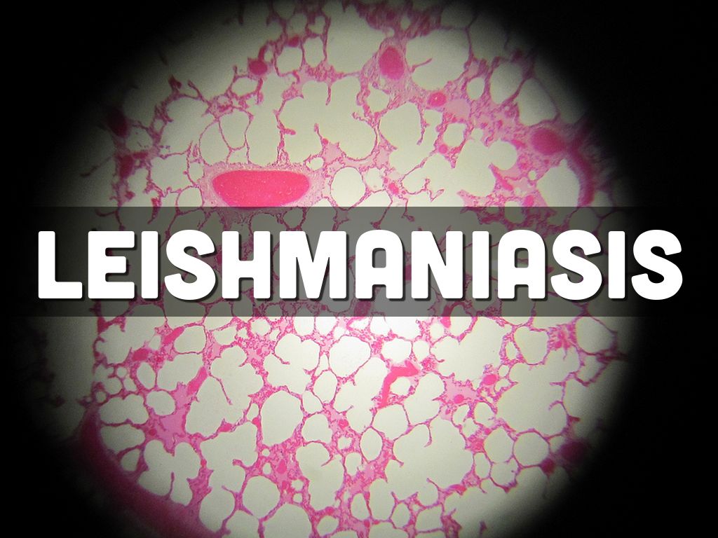 Leishmaniasis 