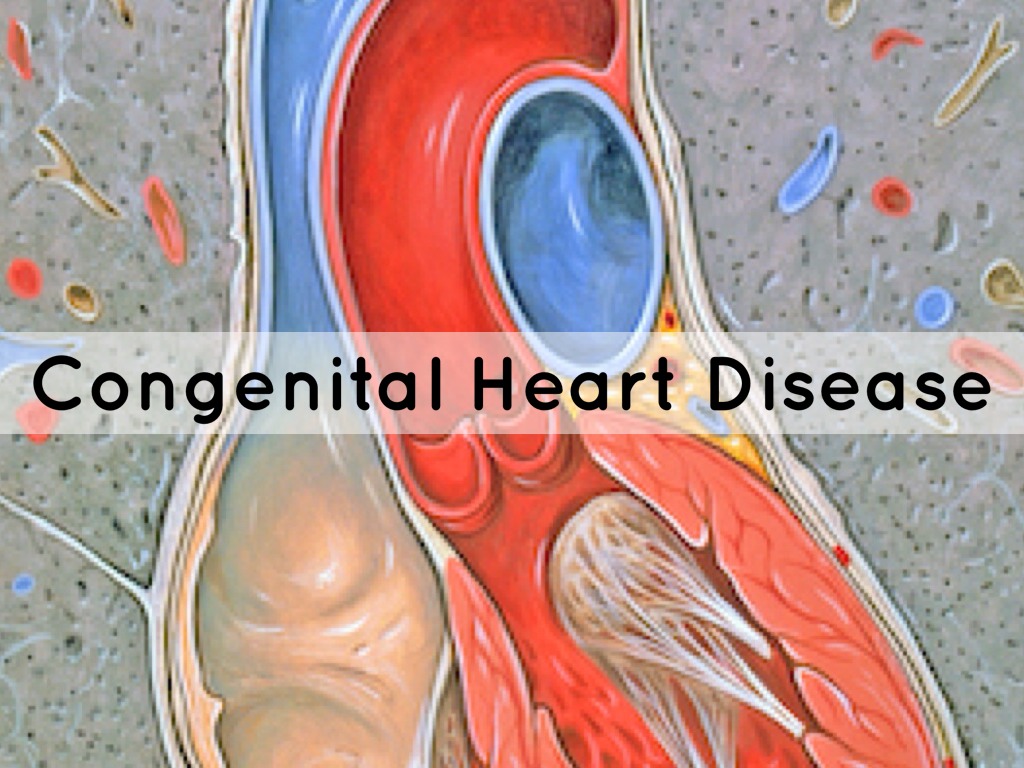 Congenital Heart Disease