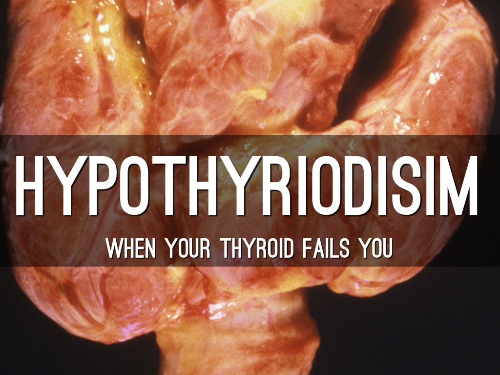 Hypothyroidisim