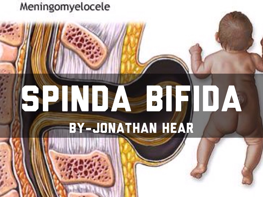 Spina Bifida