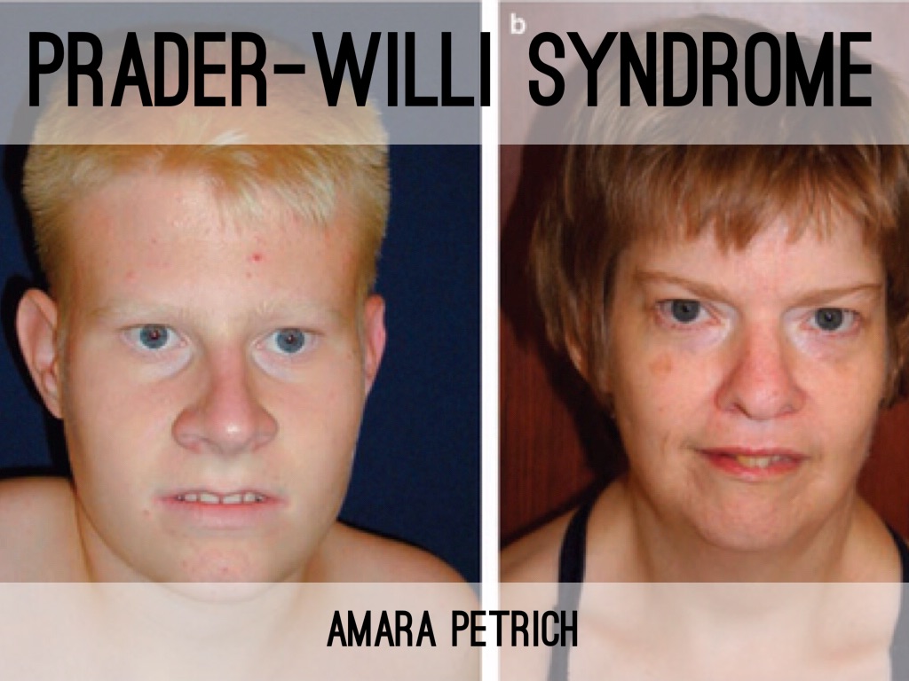 Prader Willi Syndrome By Amara Petrich