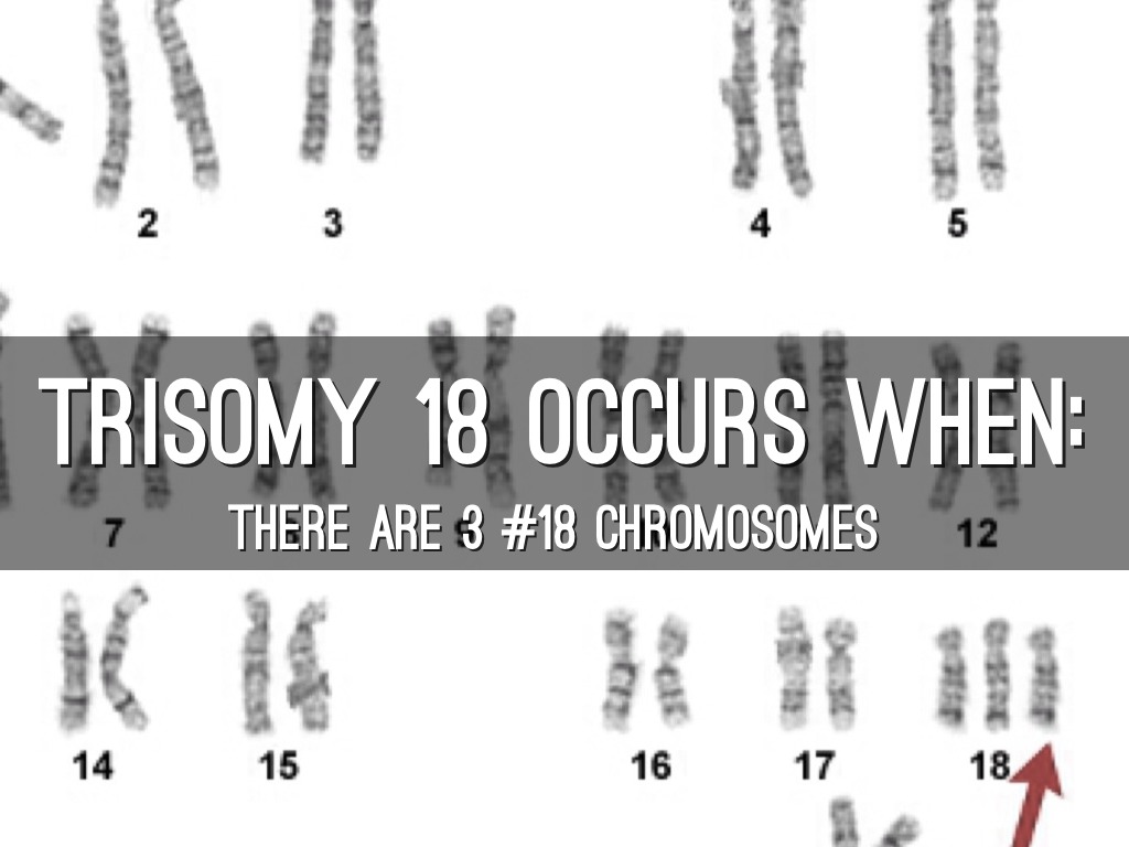 Trisomy 18 By Cierra Bergen