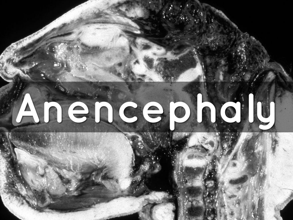 Anencephaly