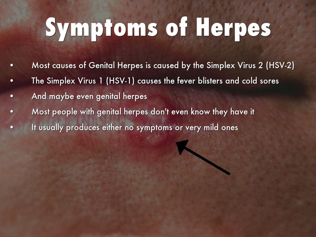 Genital herpes mild Understanding Mild