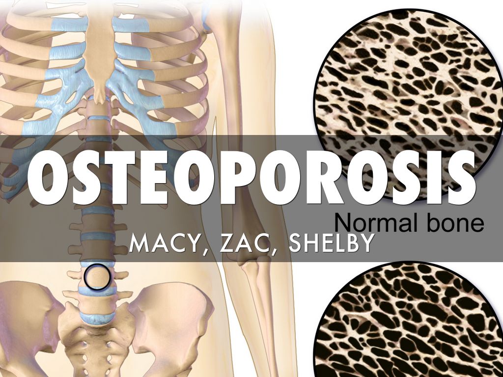Osteoporosis 