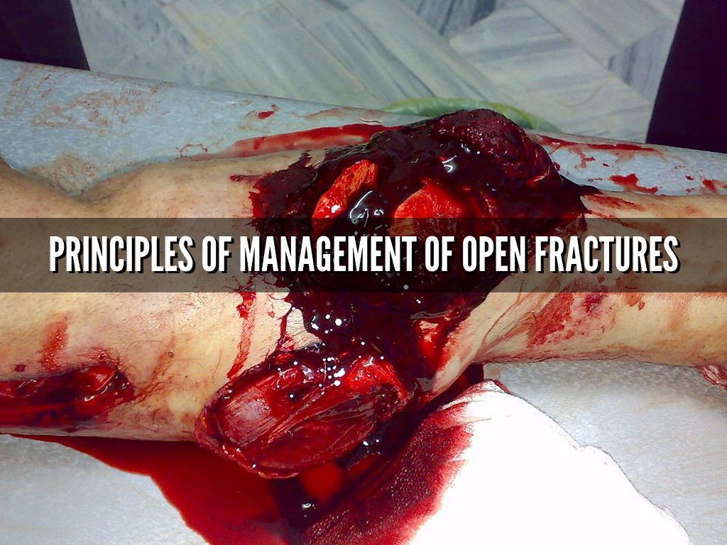 Principles of management of open fractures