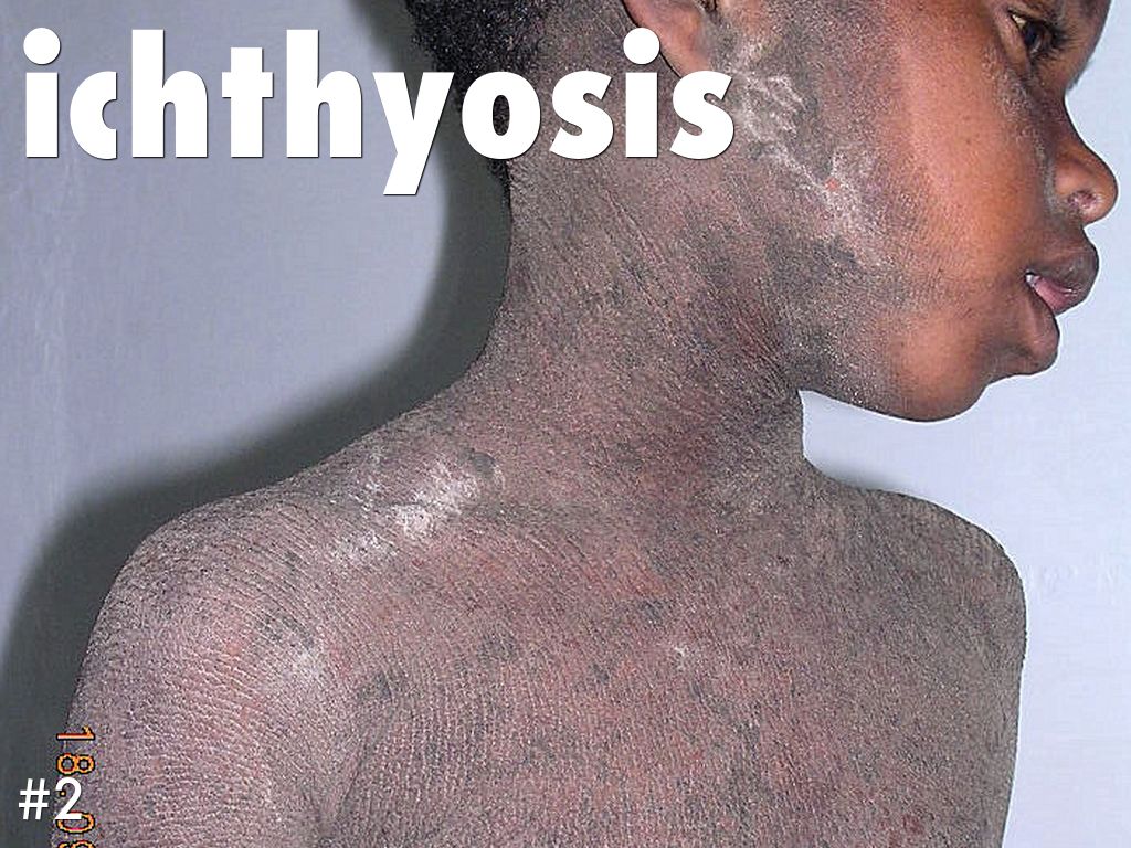 ichthyosis