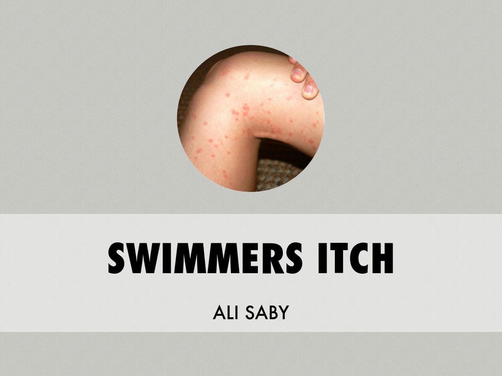 Copy of Swimmers Itch 