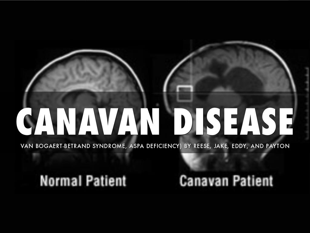 Canavan Disease by Jacob Nyborg