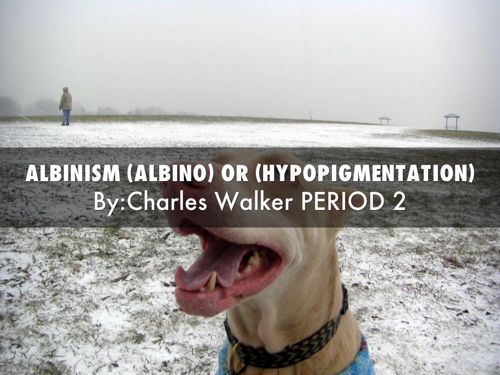 Albinism (Albino) or (Hypopigmentation)