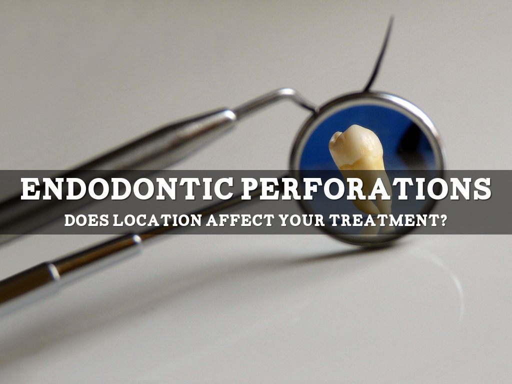 ENDODONTIC PERFORATION by Alisha Reynolds
