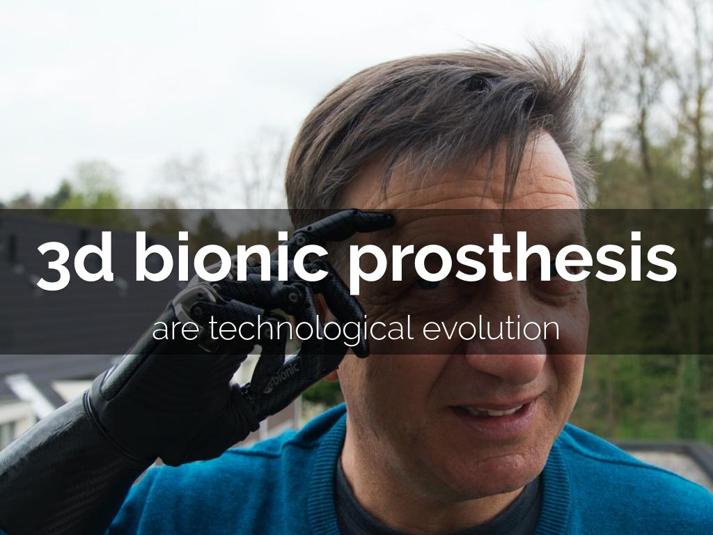 3d bionic prosthesis