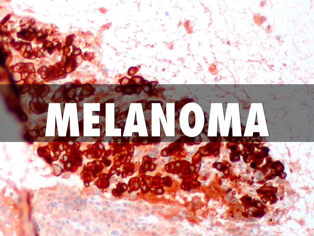 Melanoma 