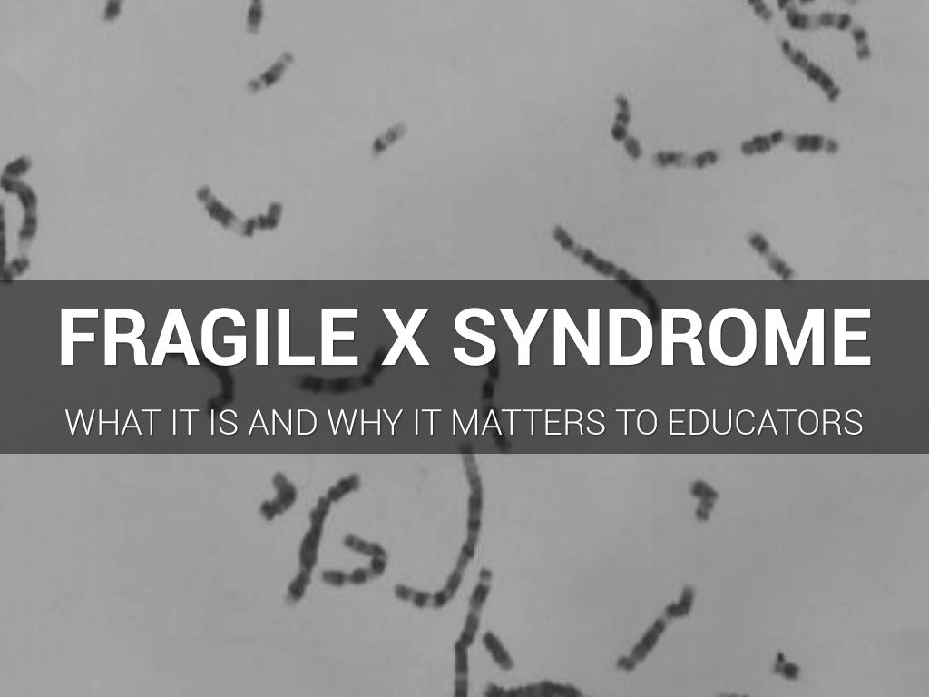 Fragile X Syndrome