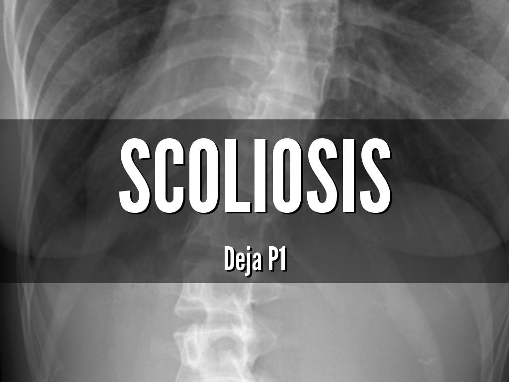 Scoliosis
