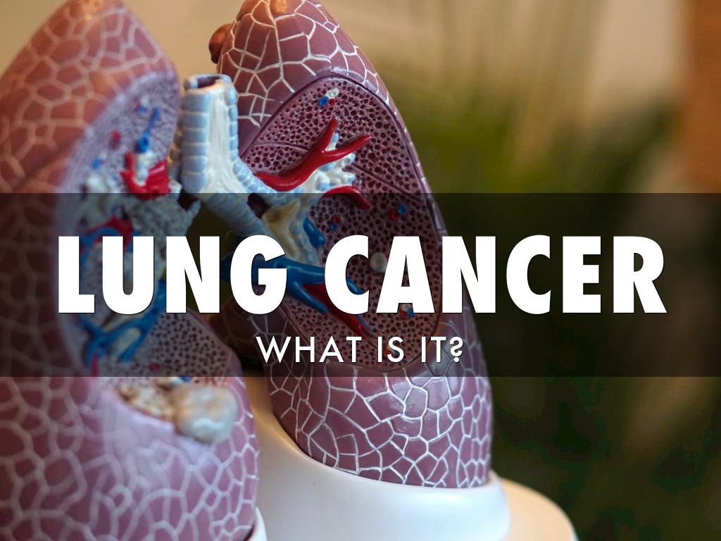 Lung Cancer.