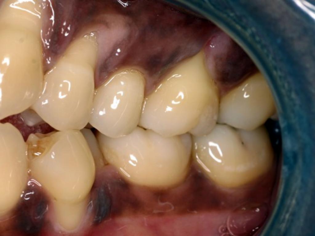 Dentinal Hypersensitivity by Michele Foster