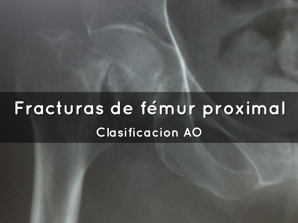 Fracturas De F mur Proximal By German Diaz Fracturas De F mur Proximal By German Diaz